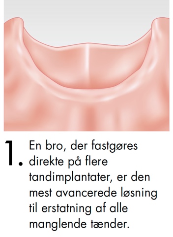En bro, der fastgøres direkte på flere tandimplantater, er den mest avancere løsning til erstatning af alle manglende tænder