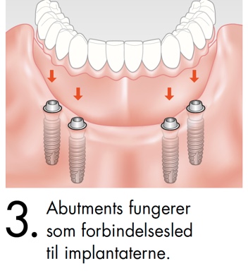Abutments fungerer som forbindelsesled til implantaterne