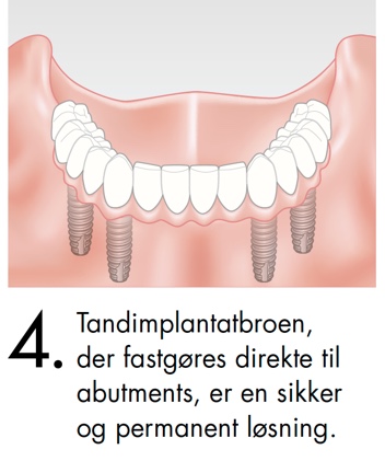 Tandimplantatbroen der fastgøres direkte til abutments, er en sikker og permanent løsning