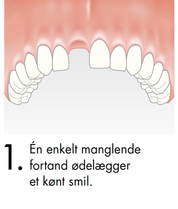 En enkelt manglende fortand ødelægger et kønt smil