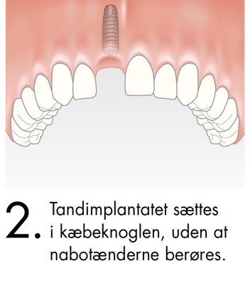 Tandimplantatet sættes i kæbeknoglen, uden at nabotænderne berøres