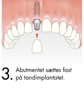 Abutmentet sættes fast på tandimplantatet