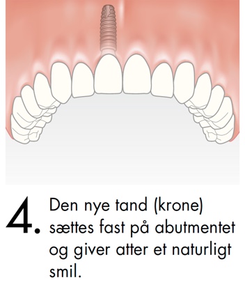 Den nye tandkrone sættes fast på abutmentet og giver atter et naturligt smil