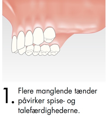 Flere manglende tænder påvirker spise- og talefærdigheder
