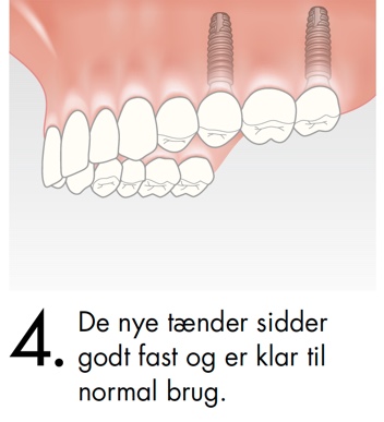 De nye tænder sidder godt fast og er klar til normal brug